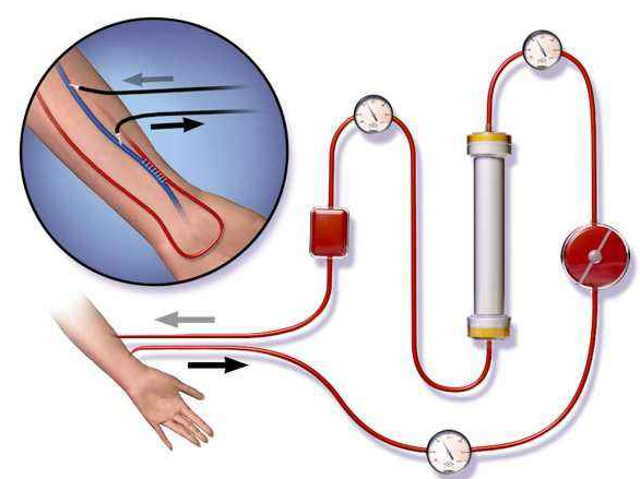 血液透析器端蓋專用塑料，你找對生產廠家了嗎？